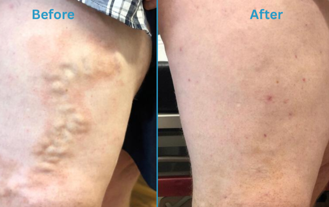 painful varicose veins